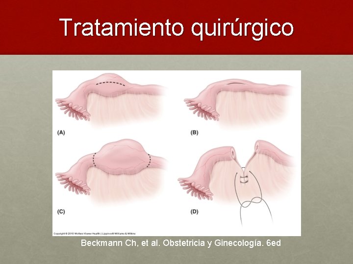 Tratamiento quirúrgico Beckmann Ch, et al. Obstetricia y Ginecología. 6 ed 