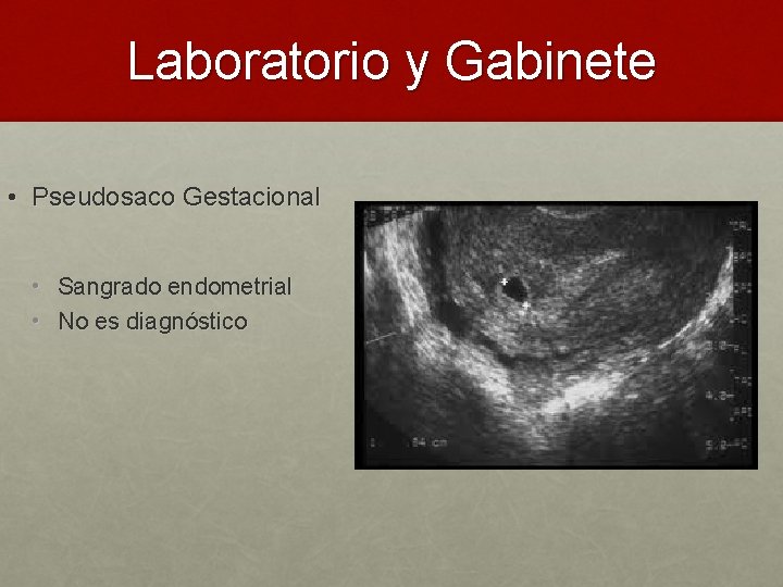 Laboratorio y Gabinete • Pseudosaco Gestacional • Sangrado endometrial • No es diagnóstico 