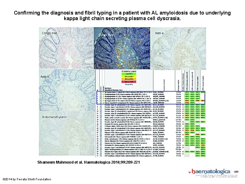 Confirming the diagnosis and fibril typing in a patient with AL amyloidosis due to