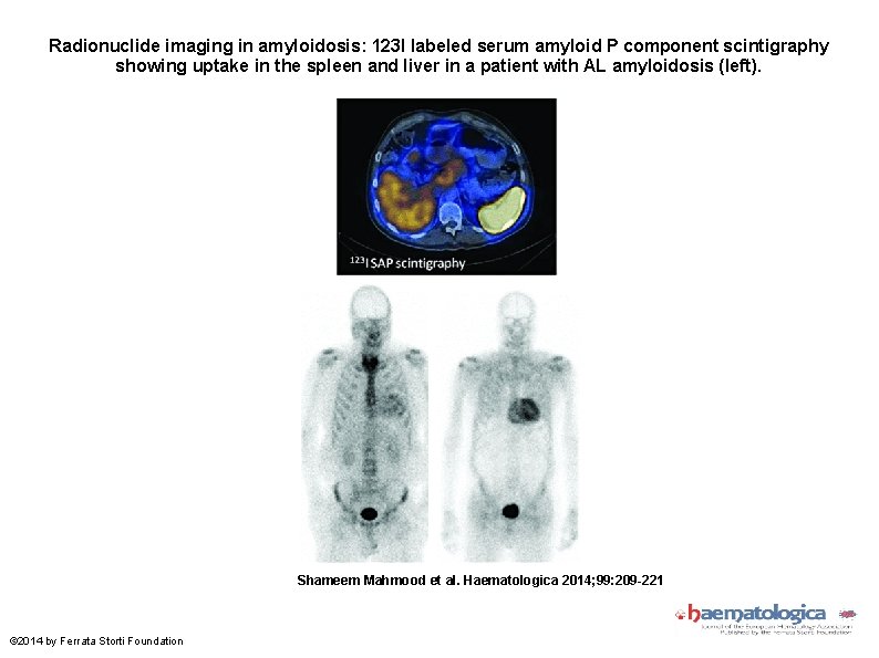 Radionuclide imaging in amyloidosis: 123 I labeled serum amyloid P component scintigraphy showing uptake