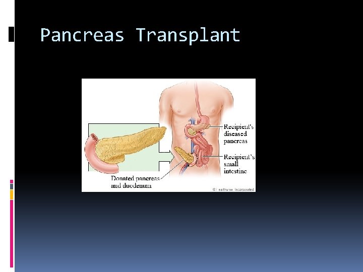 Pancreas Transplant 