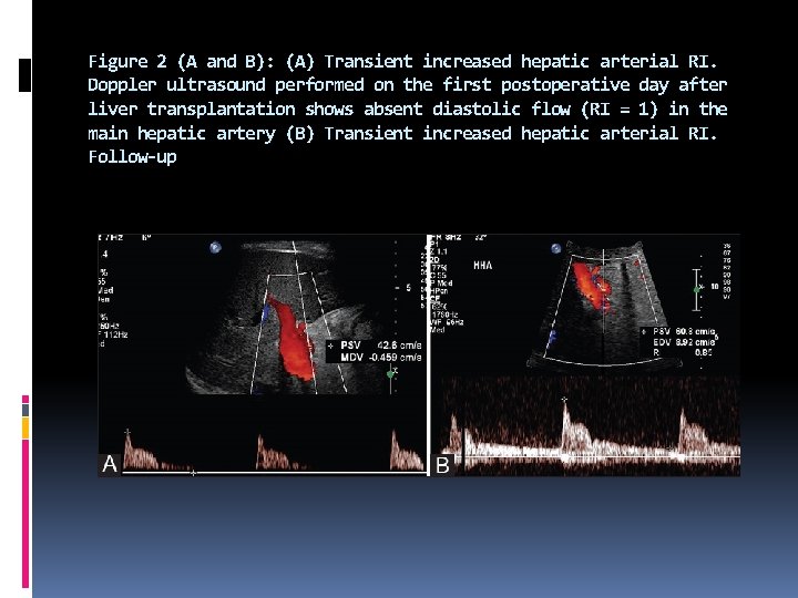 Figure 2 (A and B): (A) Transient increased hepatic arterial RI. Doppler ultrasound performed