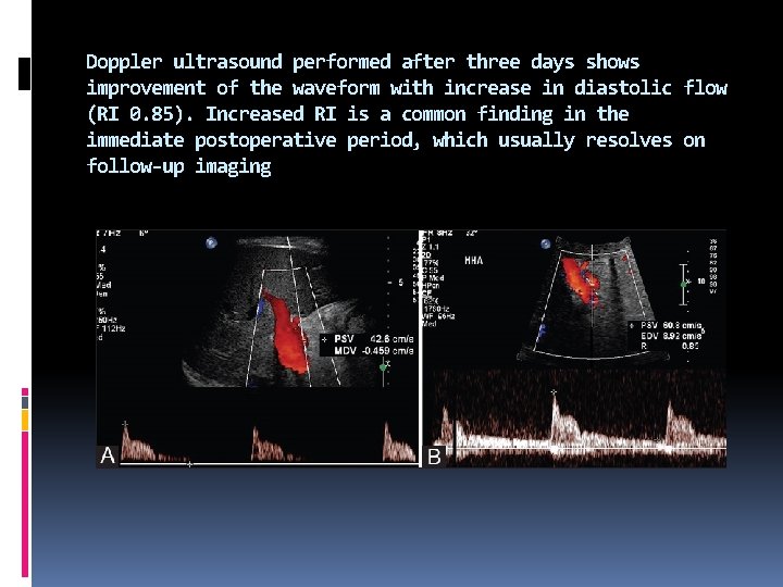 Doppler ultrasound performed after three days shows improvement of the waveform with increase in