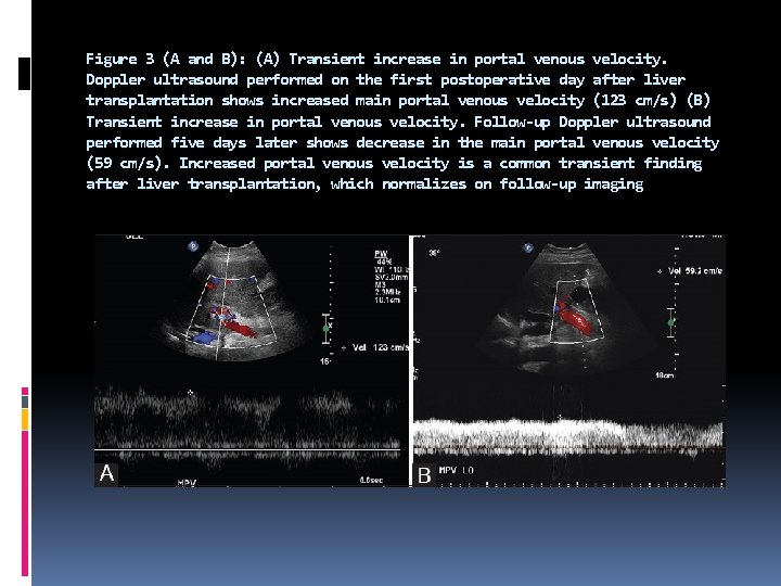 Figure 3 (A and B): (A) Transient increase in portal venous velocity. Doppler ultrasound
