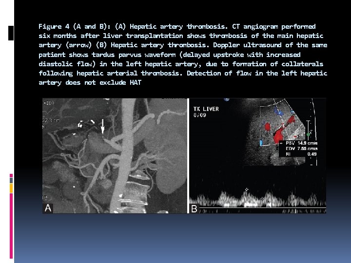 Figure 4 (A and B): (A) Hepatic artery thrombosis. CT angiogram performed six months