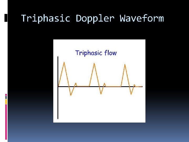 Triphasic Doppler Waveform 