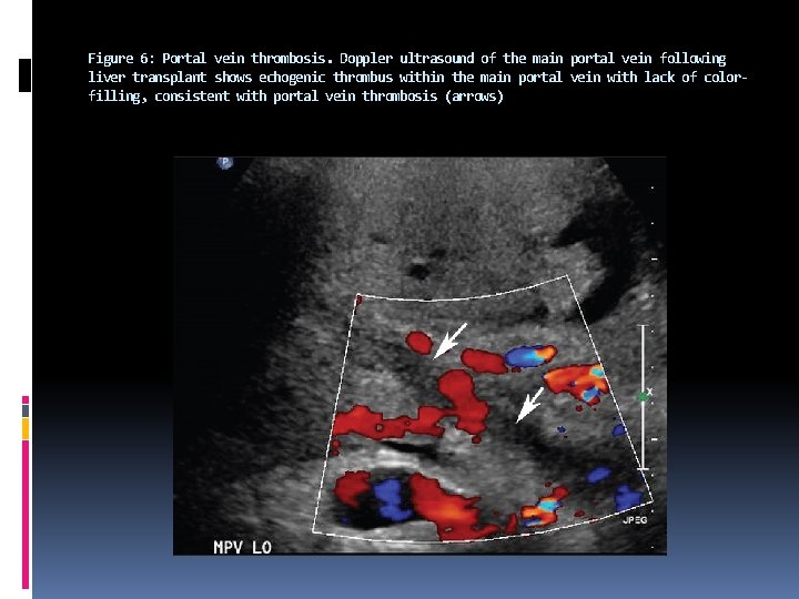 Figure 6: Portal vein thrombosis. Doppler ultrasound of the main portal vein following liver