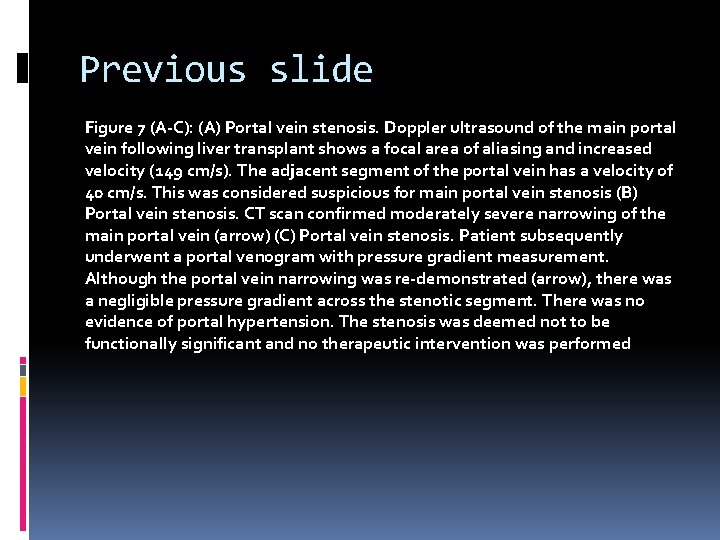 Previous slide Figure 7 (A-C): (A) Portal vein stenosis. Doppler ultrasound of the main