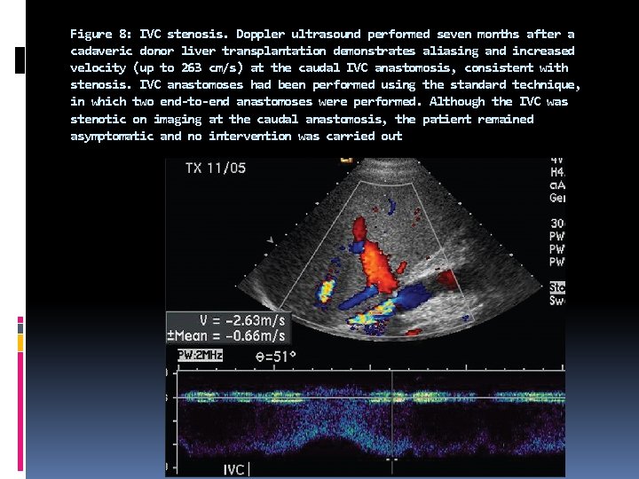 Figure 8: IVC stenosis. Doppler ultrasound performed seven months after a cadaveric donor liver