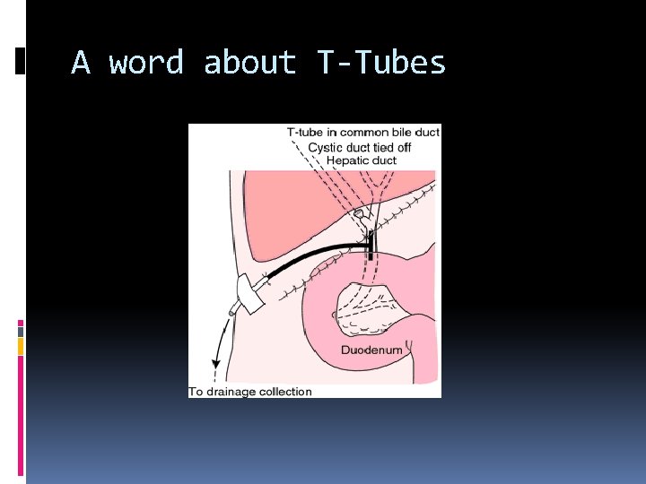 A word about T-Tubes 