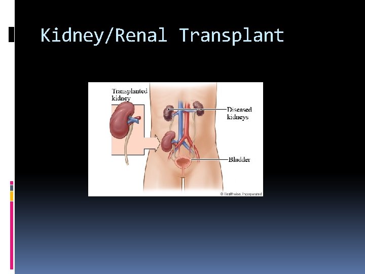 Kidney/Renal Transplant 