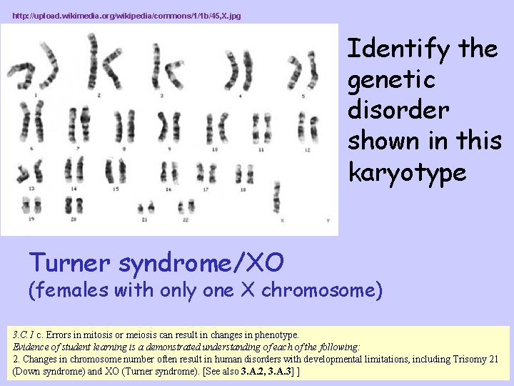 http: //upload. wikimedia. org/wikipedia/commons/1/1 b/45, X. jpg Identify the genetic disorder shown in this