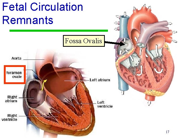 Fetal Circulation Remnants Fossa Ovalis 17 