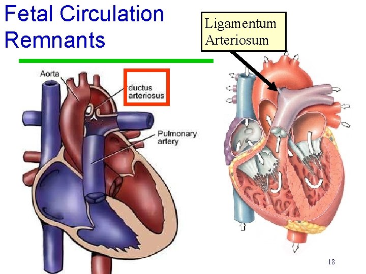 Fetal Circulation Remnants Ligamentum Arteriosum 18 