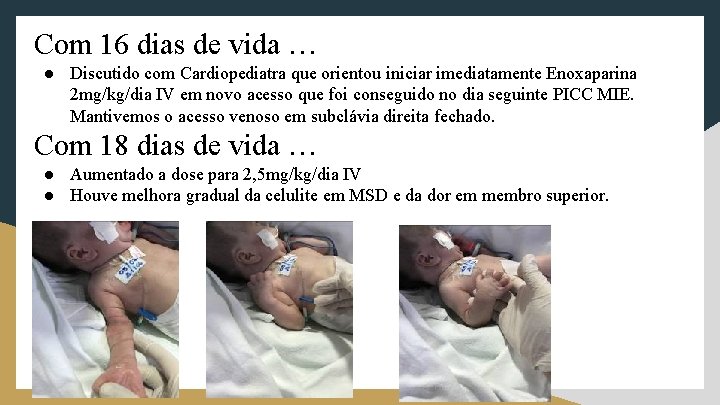 Com 16 dias de vida … ● Discutido com Cardiopediatra que orientou iniciar imediatamente