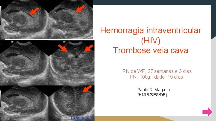 Hemorragia intraventricular (HIV) Trombose veia cava RN de WF, 27 semanas e 3 dias