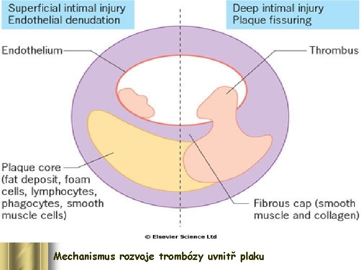 Mechanismus rozvoje trombózy uvnitř plaku 