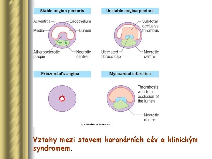 Vztahy mezi stavem koronárních cév a klinickým syndromem 