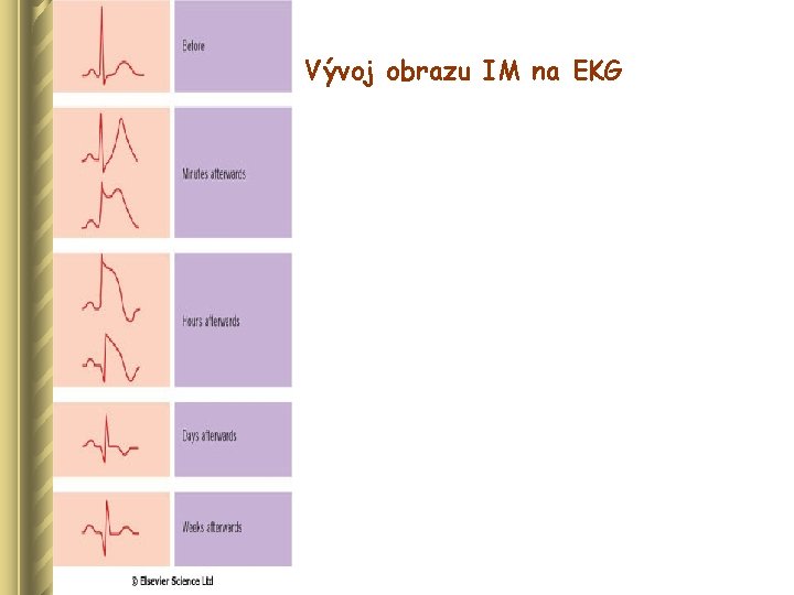 Vývoj obrazu IM na EKG 