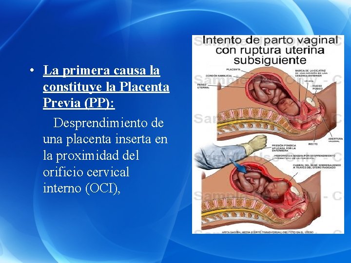  • La primera causa la constituye la Placenta Previa (PP): Desprendimiento de una