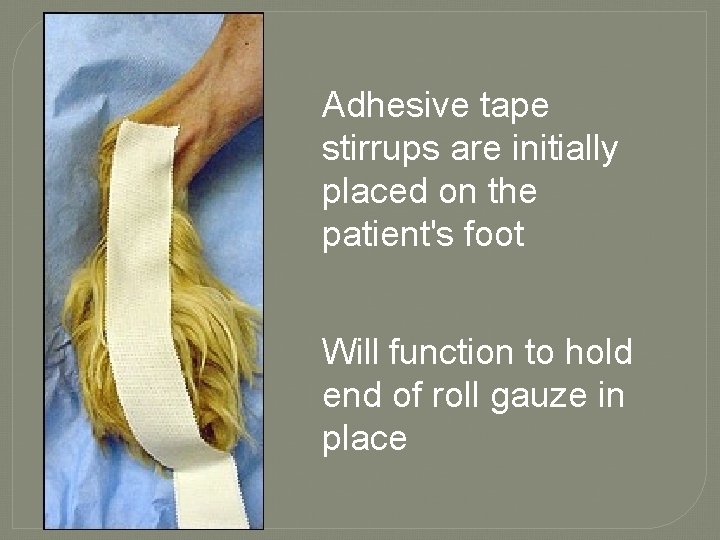 Adhesive tape stirrups are initially placed on the patient's foot Will function to hold