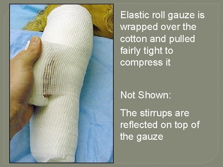 Elastic roll gauze is wrapped over the cotton and pulled fairly tight to compress