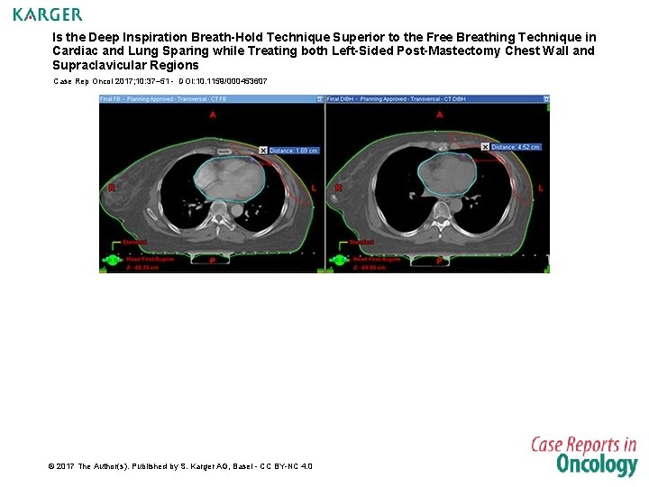 Is the Deep Inspiration Breath-Hold Technique Superior to the Free Breathing Technique in Cardiac