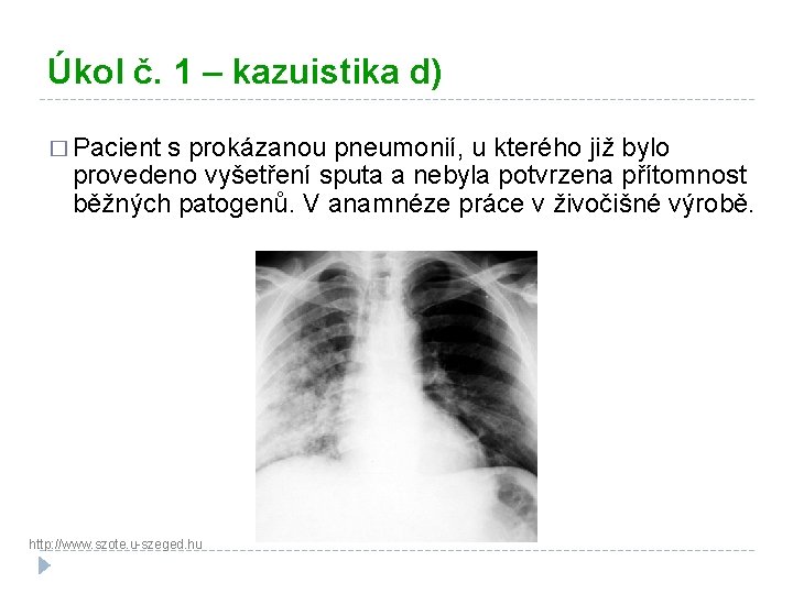 Úkol č. 1 – kazuistika d) � Pacient s prokázanou pneumonií, u kterého již