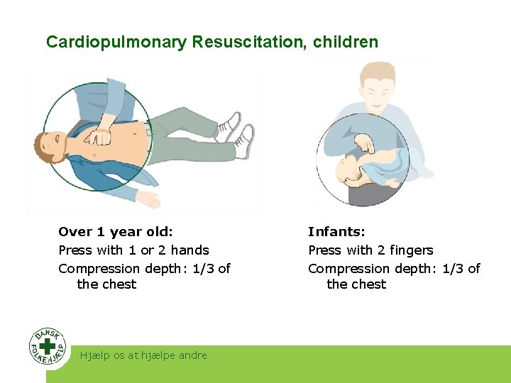Cardiopulmonary Resuscitation, children Over 1 year old: Press with 1 or 2 hands Compression
