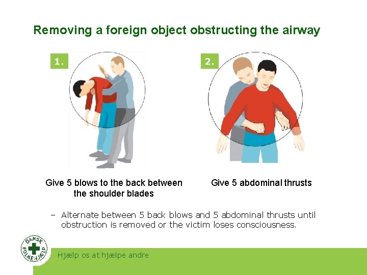 Removing a foreign object obstructing the airway 1. Give 5 blows to the back