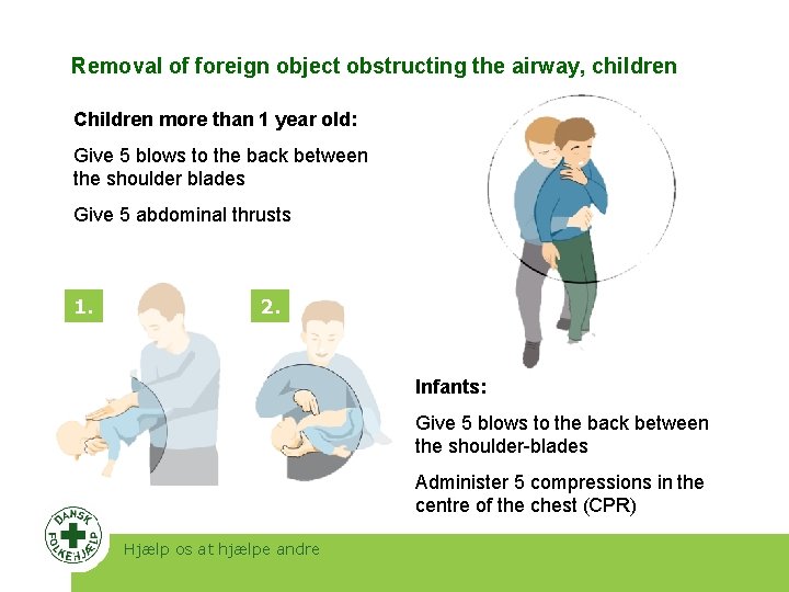Removal of foreign object obstructing the airway, children Children more than 1 year old: