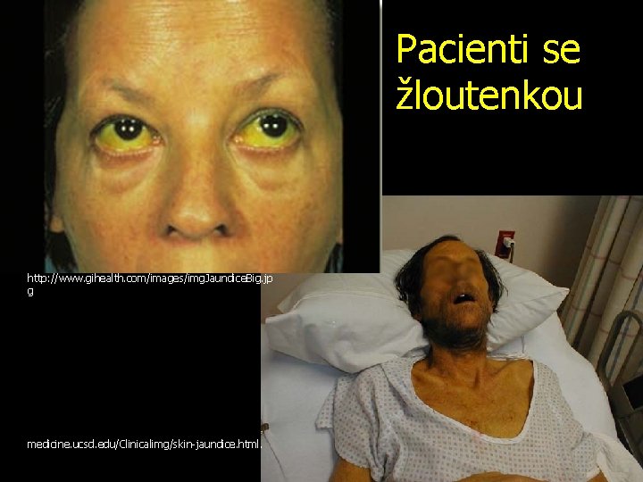 Pacienti se žloutenkou http: //www. gihealth. com/images/img. Jaundice. Big. jp g medicine. ucsd. edu/Clinicalimg/skin-jaundice.
