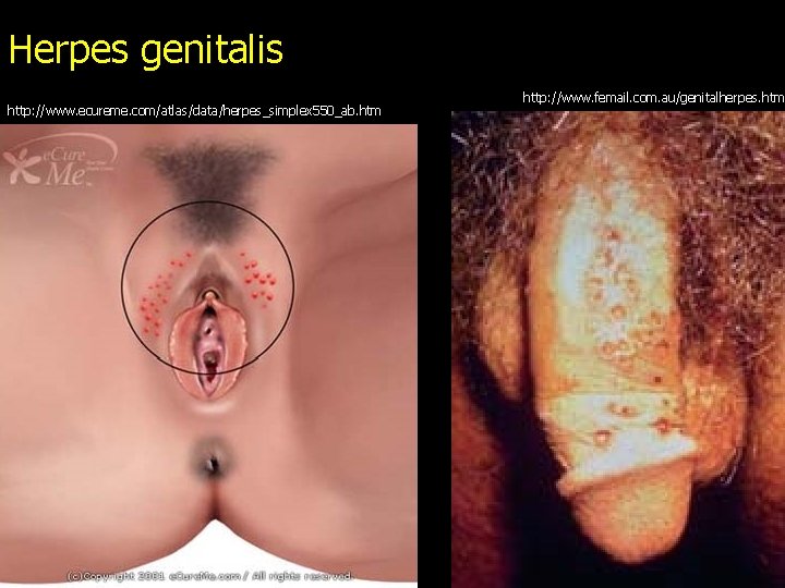 Herpes genitalis http: //www. ecureme. com/atlas/data/herpes_simplex 550_ab. htm http: //www. femail. com. au/genitalherpes. htm