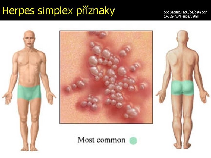 Herpes simplex příznaky opt. pacificu. edu/ce/catalog/ 14382 -AS/Herpes. html 