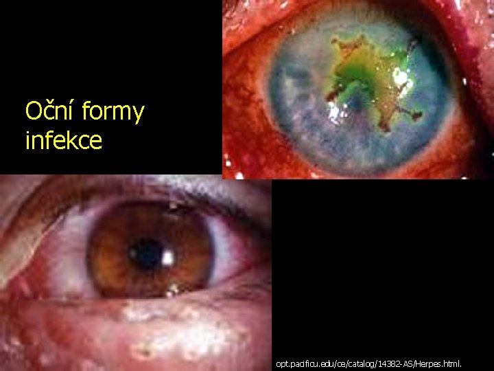 Oční formy infekce opt. pacificu. edu/ce/catalog/14382 -AS/Herpes. html. 
