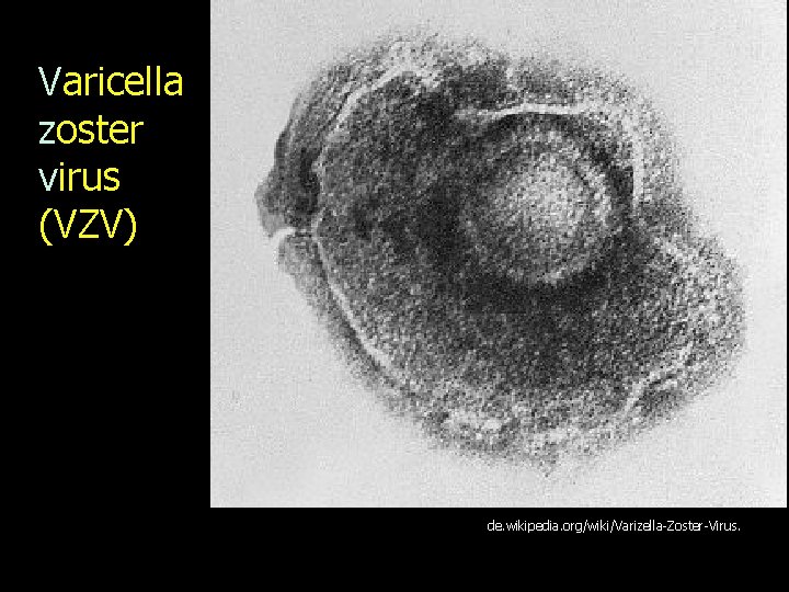 Varicella zoster virus (VZV) de. wikipedia. org/wiki/Varizella-Zoster-Virus. 