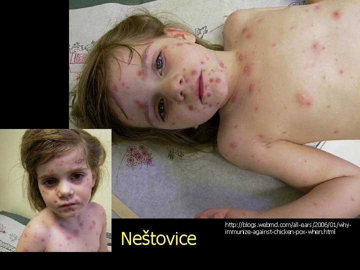 Neštovice http: //blogs. webmd. com/all-ears/2006/01/whyimmunize-against-chicken-pox-when. html 