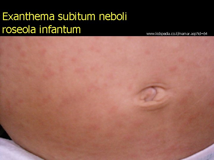 Exanthema subitum neboli roseola infantum www. kidspedia. co. il/mamar. asp? id=64 