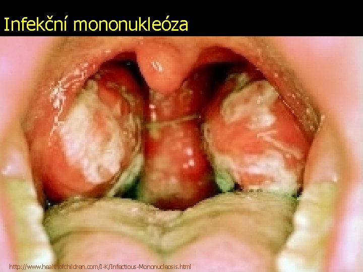 Infekční mononukleóza http: //www. healthofchildren. com/I-K/Infectious-Mononucleosis. html 