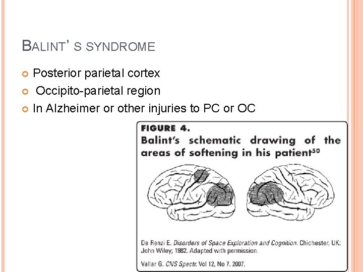 BALINT’ S SYNDROME Posterior parietal cortex Occipito-parietal region In Alzheimer or other injuries to