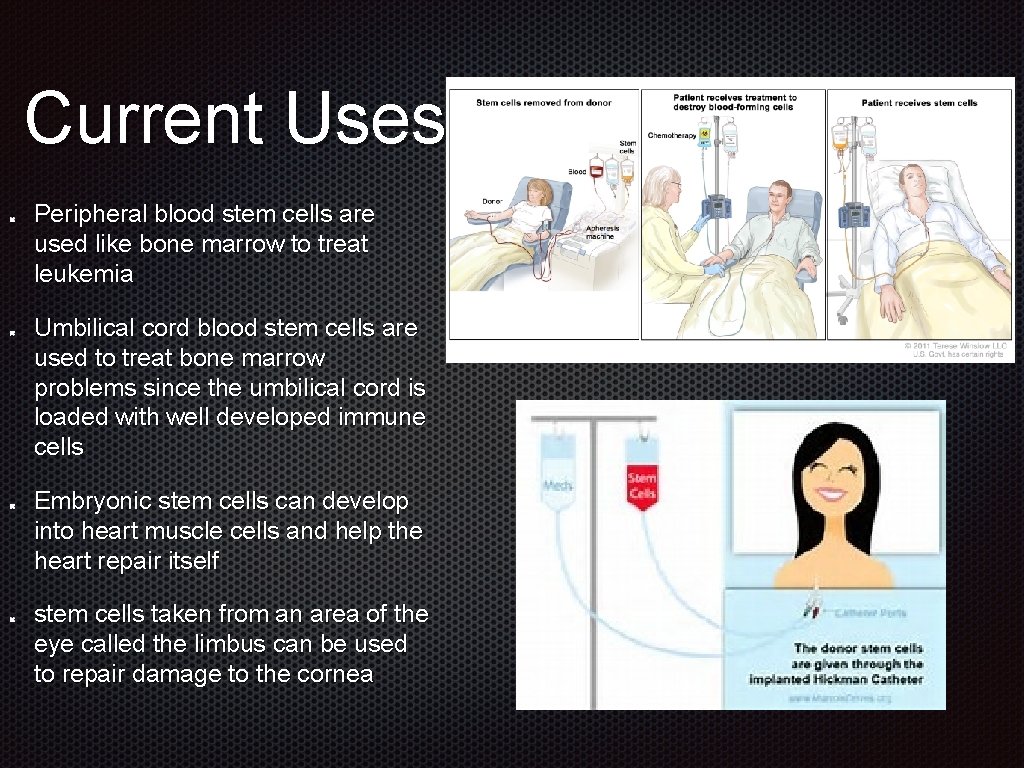 Current Uses Peripheral blood stem cells are used like bone marrow to treat leukemia