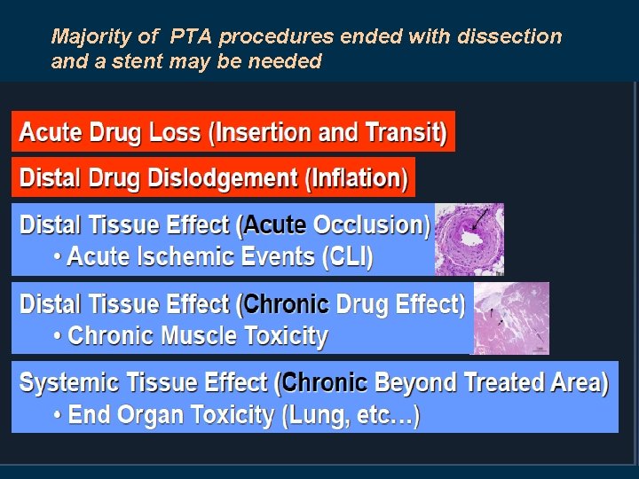 Majority of PTA procedures ended with dissection and a stent may be needed 