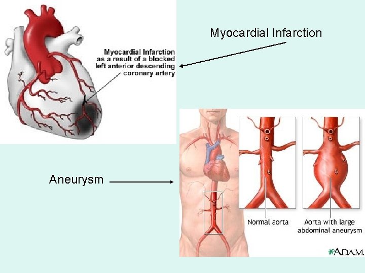 Myocardial Infarction Aneurysm 