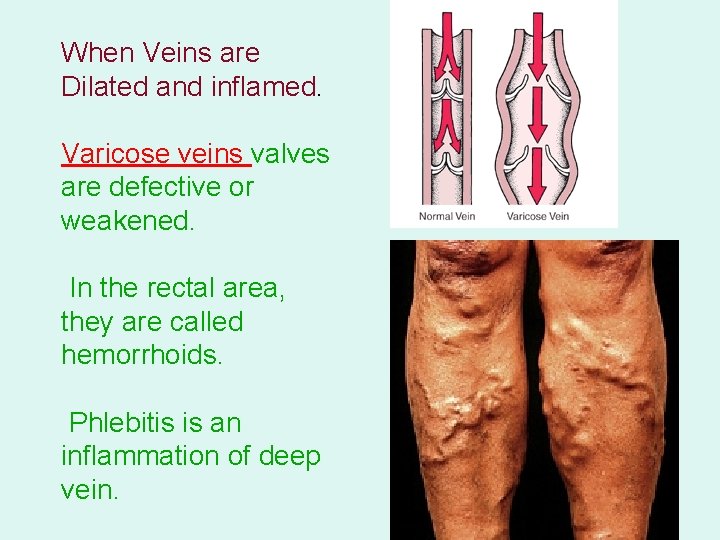 When Veins are Dilated and inflamed. Varicose veins valves are defective or weakened. In