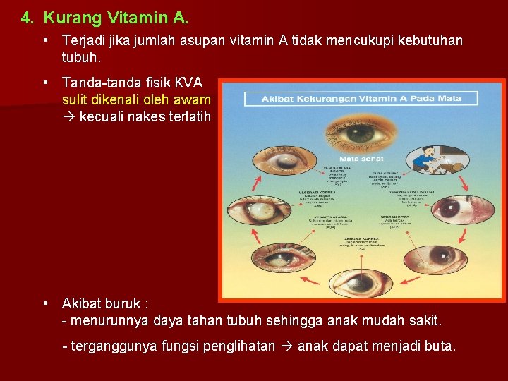 4. Kurang Vitamin A. • Terjadi jika jumlah asupan vitamin A tidak mencukupi kebutuhan