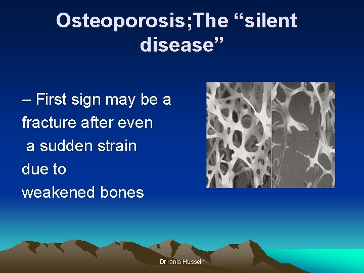 Osteoporosis; The “silent disease” – First sign may be a fracture after even a