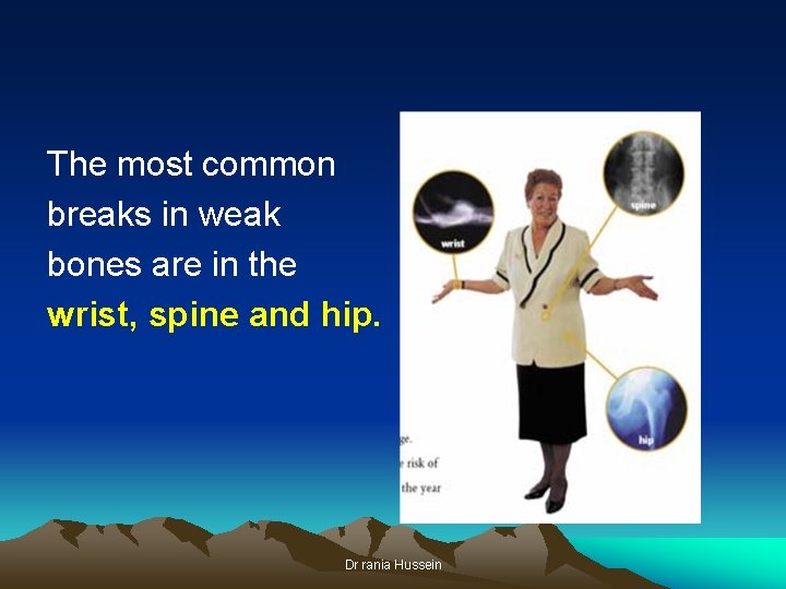 The most common breaks in weak bones are in the wrist, spine and hip.