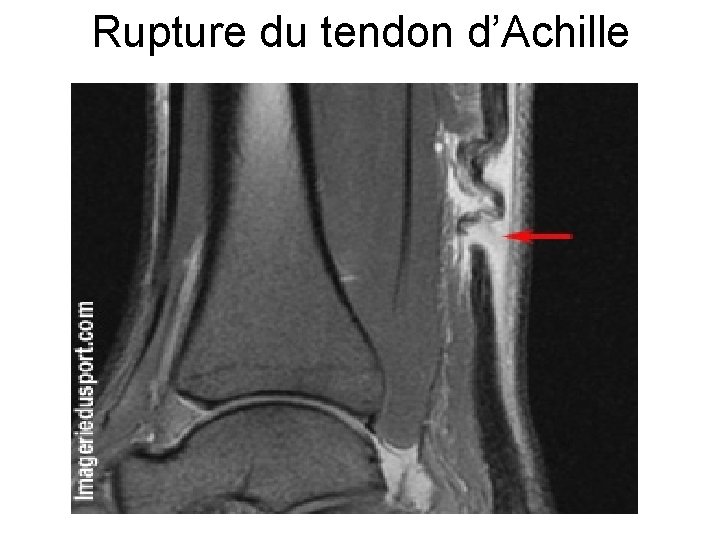 Rupture du tendon d’Achille 