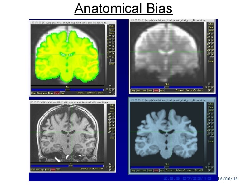 Anatomical Bias Z. S. S 16/06/13 