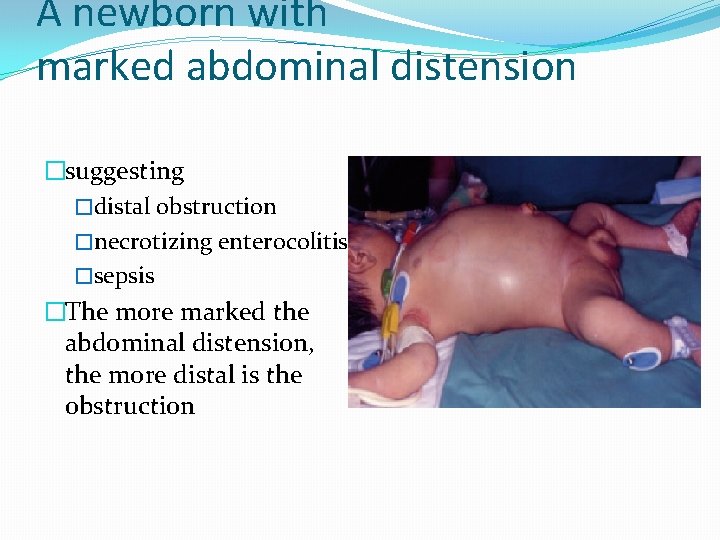 A newborn with marked abdominal distension �suggesting �distal obstruction �necrotizing enterocolitis �sepsis �The more